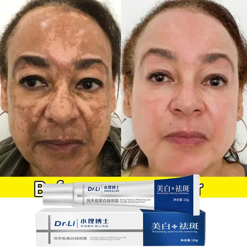 7-Day Melasma & Freckles Whitening Cream: Fade Dark Spots, Brighten Skin - Korean Skincare