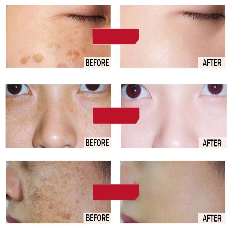 Korean Melasma & Freckle Whitening Cream: Anti-Brown Stain Skincare