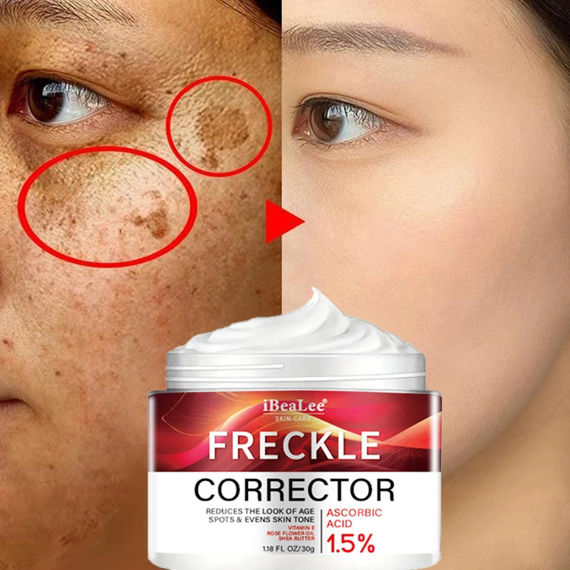 Korean Melasma & Freckle Whitening Cream: Anti-Brown Stain Skincare