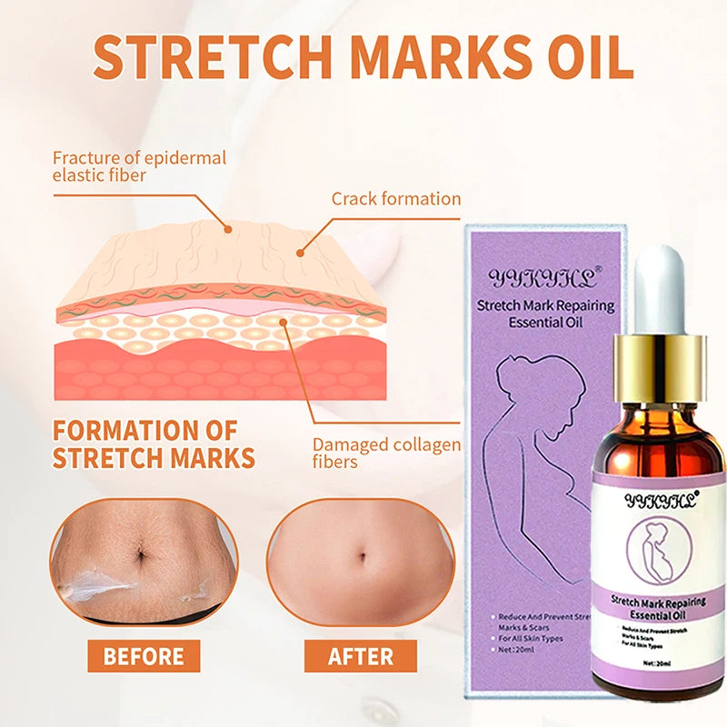 Maternity Stretch Marks Repair Oil: Enhance Skin Elasticity and Firmness