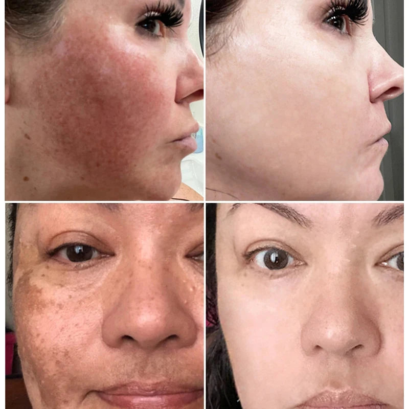 7-Day Melasma & Freckles Whitening Cream: Fade Dark Spots, Brighten Skin - Korean Skincare