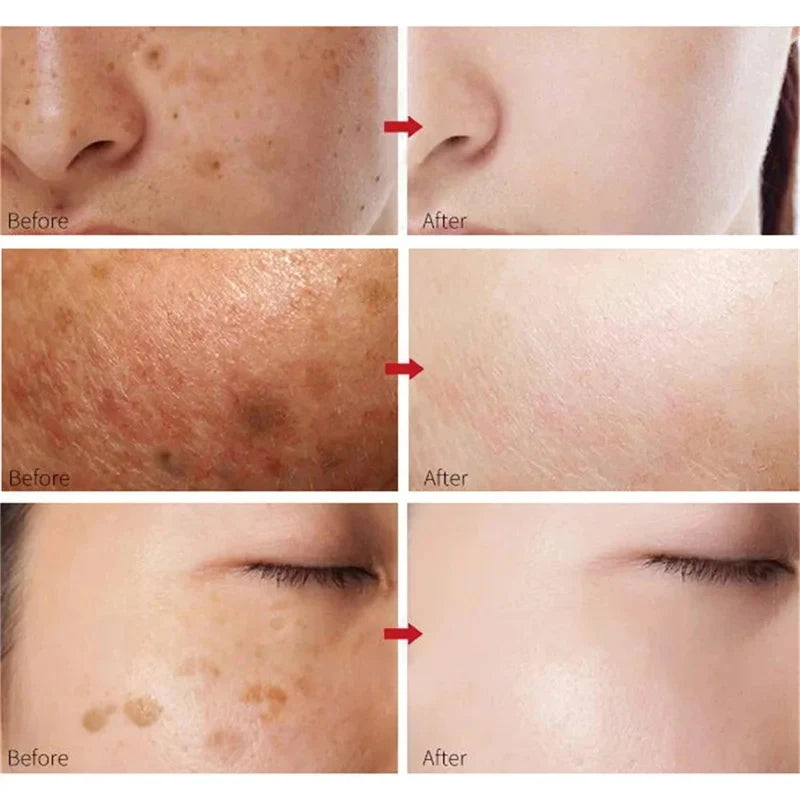 7-Day Melasma & Freckles Whitening Cream: Fade Dark Spots, Brighten Skin - Korean Skincare